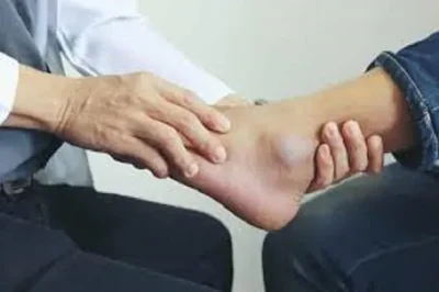 شکستگی مچ پا