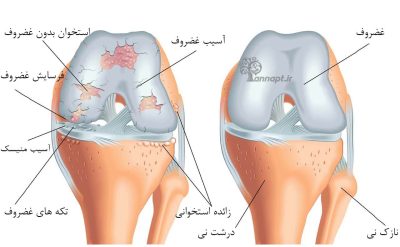 علت زانو درد در 30 سالگی
