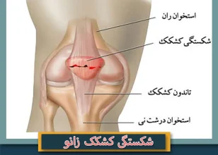 شکستگی کشکک زانو