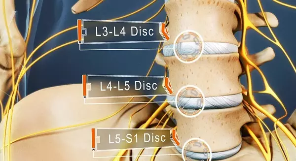 علائم دیسک کمر چیست و چگونه باید آن را درمان کرد؟